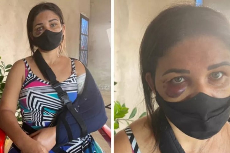 (Adriana foi submetida a uma cirurgia em função da fratura em um dos braços e recebeu alta no domingo (13). Foto: Reprodução/TV Tem) (Adriana foi submetida a uma cirurgia em função da fratura em um dos braços e recebeu alta no domingo (13). Foto: Reprodução/TV Tem)
