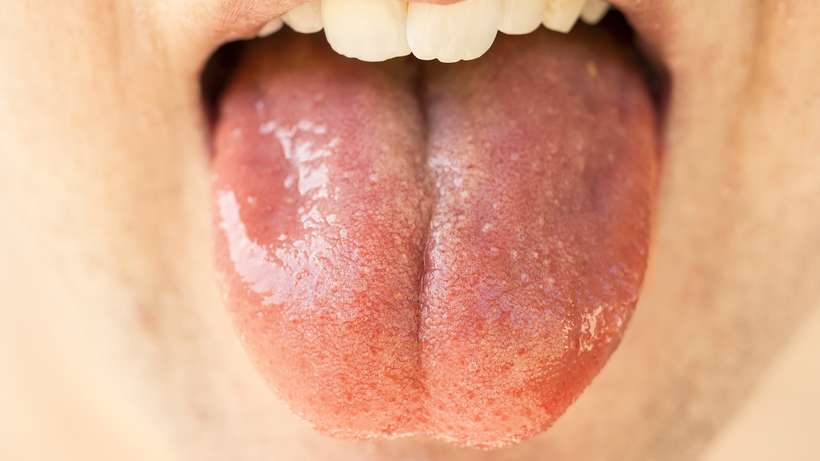 Covid-19 infecta e se replica nas glândulas salivares - Vimarsana News