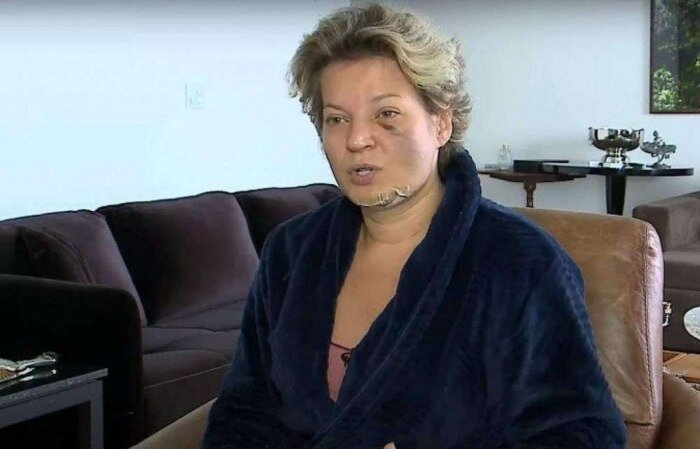 (Parlamentar acordo com o rosto cheia de fraturas, mas não sabe se caiu da cama ou foi agredida por alguém que invadiu o apartamento. Foto: Reprodução/SBT) (Parlamentar acordo com o rosto cheia de fraturas, mas não sabe se caiu da cama ou foi agredida por alguém que invadiu o apartamento. Foto: Reprodução/SBT)