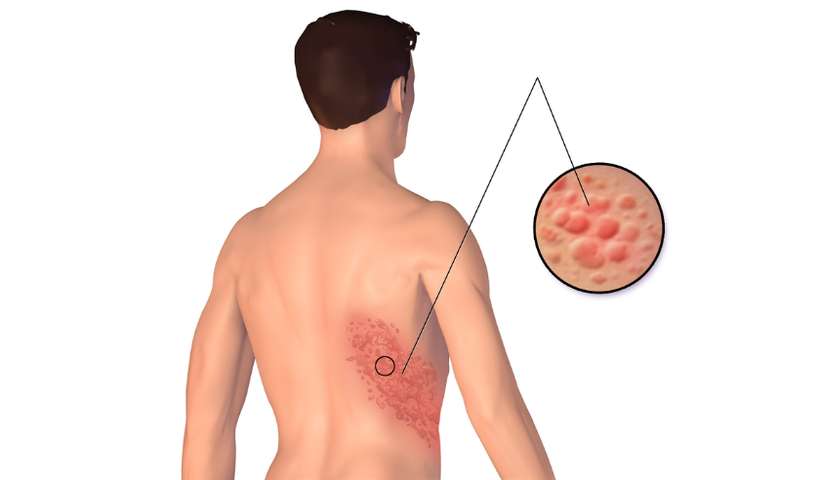 (Covid-19 tem relação com aumento de casos de herpes-zoster em adultos. Foto: Commons Wikimédia/Reprodução ) (Covid-19 tem relação com aumento de casos de herpes-zoster em adultos. Foto: Commons Wikimédia/Reprodução )