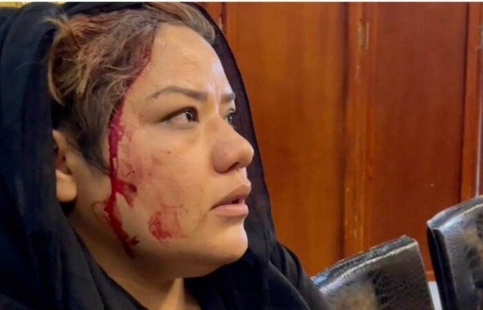 Razia Barak Haidari, 26 anos, foi socada na orelha (Foto: material cedido ao Correio Braziliense
) Razia Barak Haidari, 26 anos, foi socada na orelha (Foto: material cedido ao Correio Braziliense
)