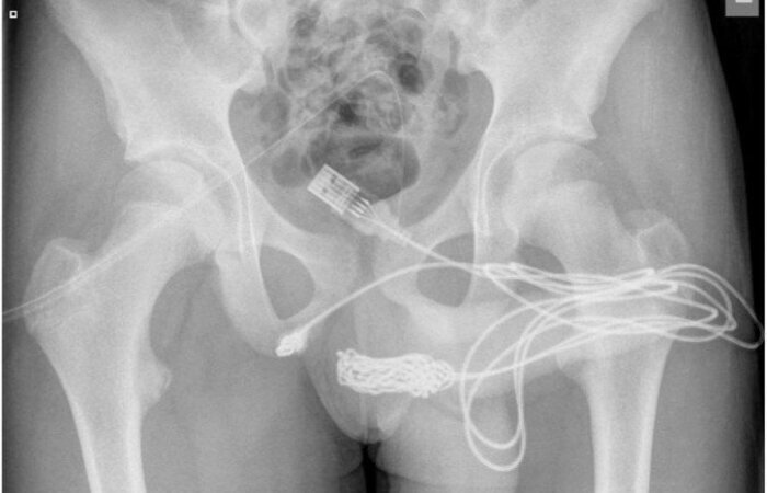 (Foto: Calum Grant/Urology Case Reports) (Foto: Calum Grant/Urology Case Reports)