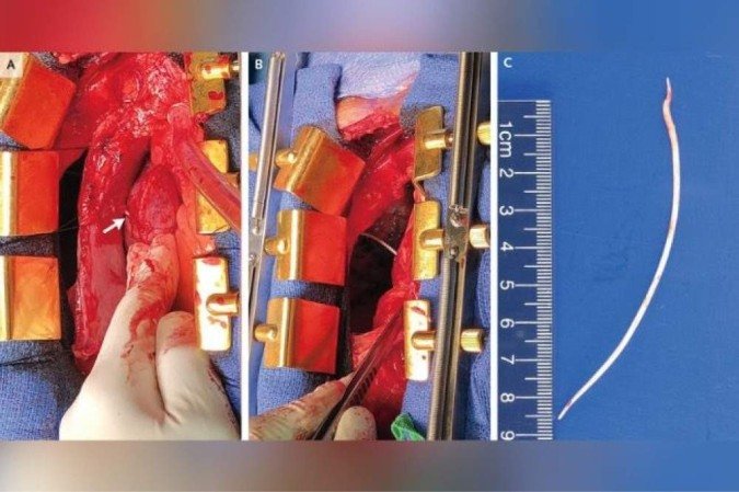 (O objeto tinha 10,1 centímetros de comprimento e já perfurava o coração e o pulmão do paciente, além de obstruir a passagem de sangue nas veias. Foto: The New England Journal of Medicine) (O objeto tinha 10,1 centímetros de comprimento e já perfurava o coração e o pulmão do paciente, além de obstruir a passagem de sangue nas veias. Foto: The New England Journal of Medicine)