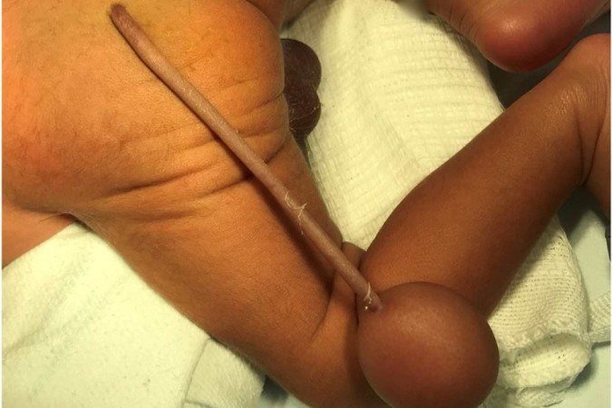  (Em toda a literatura mundial, somente 40 casos do tipo foram relatados: a identificao em uma publicao de tamanha importncia de um caso no Brasil ajuda a levantar mais conhecimentos. Foto: Reproduo/Journal of Pediatric Surgery Case Reports)