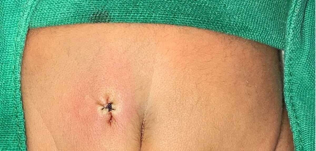  (Caso de beb que nasceu com uma espcie de "cauda" em Fortaleza. Foto: Reproduo/Journal of Pediatric Surgery Case Reports)