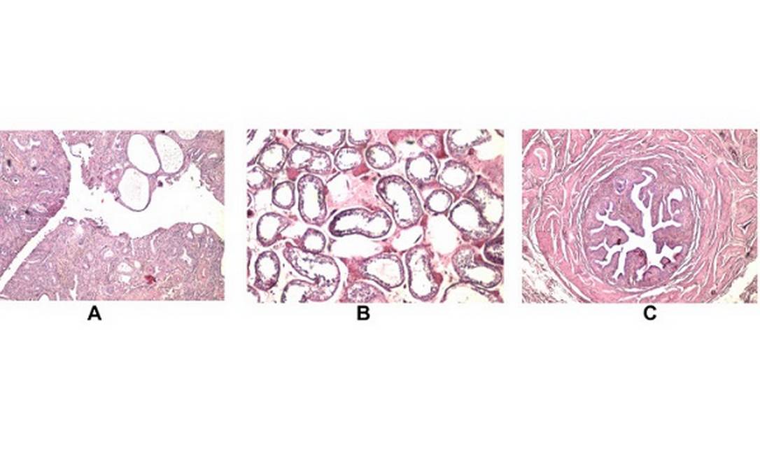 tero e endomtrio (A); Tuba e epiddimo (B) e testculo (C) descobertos em paciente durante cirugia de hrnia  (Foto: Reproduo/Urology Case Reports)