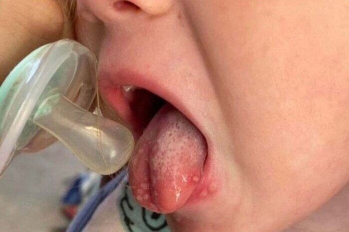 Nao Deixe Ninguem Beijar Seu Bebe Alerta Mae Apos Filha Contrair Herpes Dp Mais Saude Diario De Pernambuco Nao Deixe Ninguem Beijar Seu Bebe Alerta Mae Apos Filha Contrair Herpes Dp Mais Saude Diario De Pernambuco