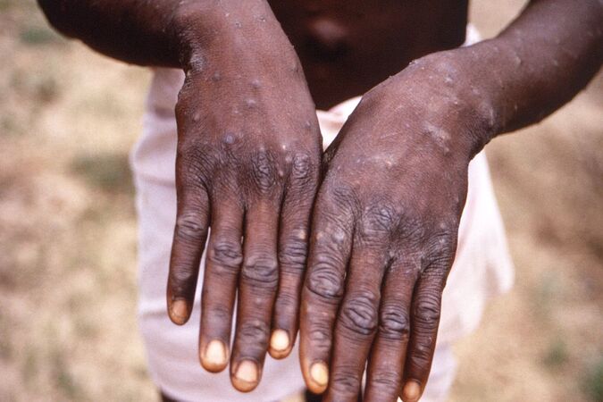 A varíola dos macacos é uma doença infecciosa que geralmente é leve e é endêmica em partes da África ocidental e central. (CDC/Bryan W. J. Mahy
)