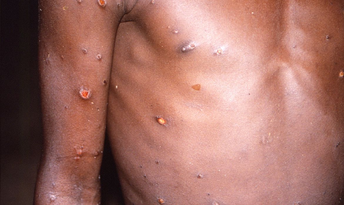  (Estudo indica que vírus pertence à região da África Ocidental. Foto: CDC/Brian W.J.Mahy)