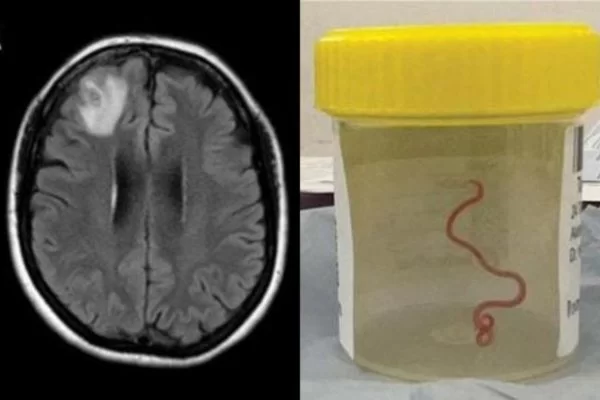  (https://www.metropoles.com/saude/verme-de-8-cm-cerebro-humano)