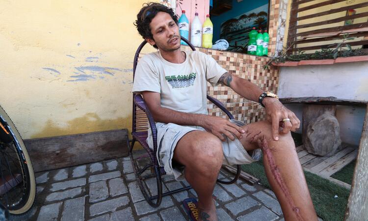 Andr Sthwart  Luiz Gomes da Silva, de 33 anos,  pai de 5 filhos e est desempregado e sem poder trabalhar por causa das sequelas que a mordida deixou em sua perna esquerda (Foto: Ruan Pablo/DP Foto)